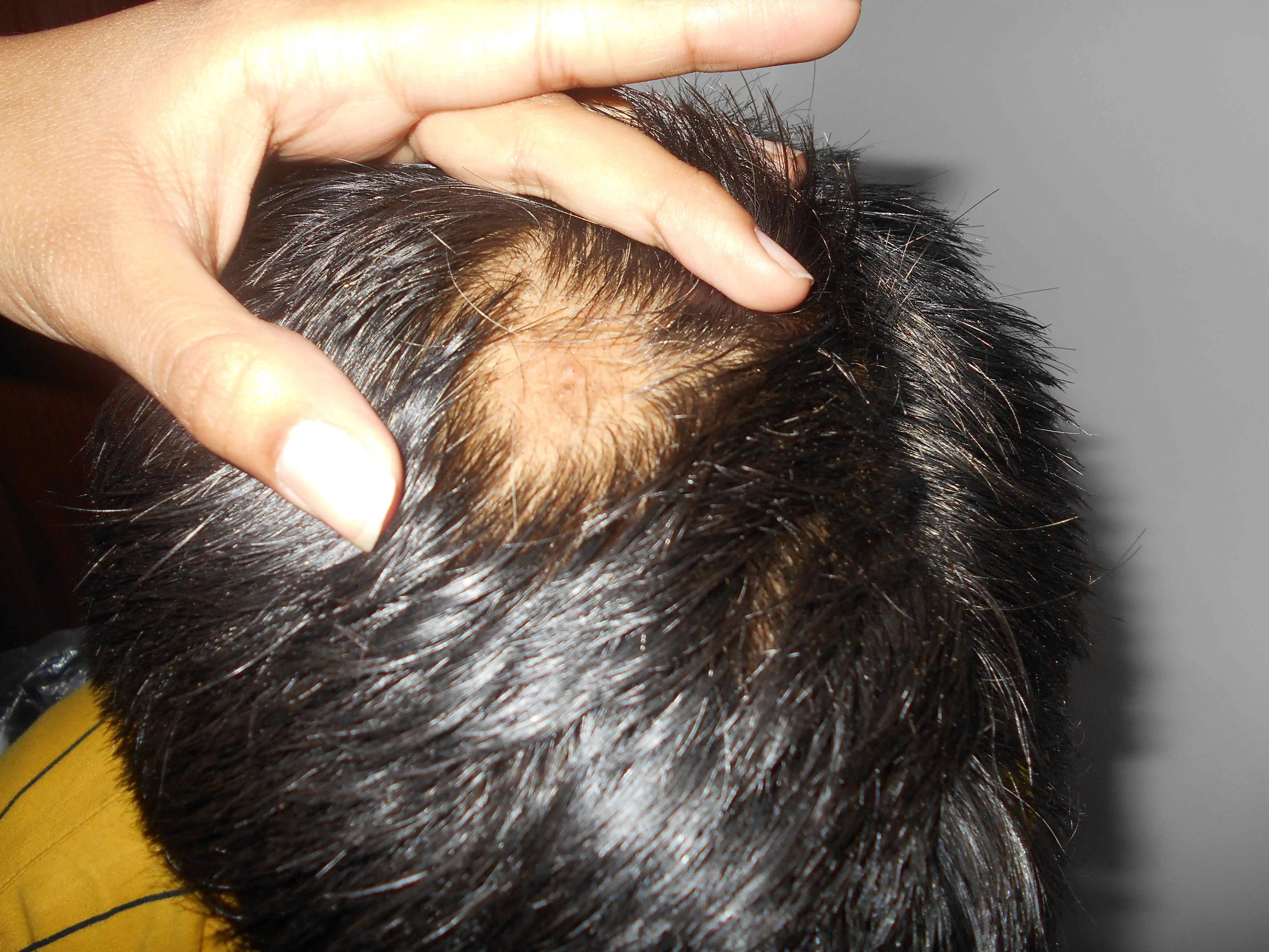 Alopecia Areata Treatment in Indore